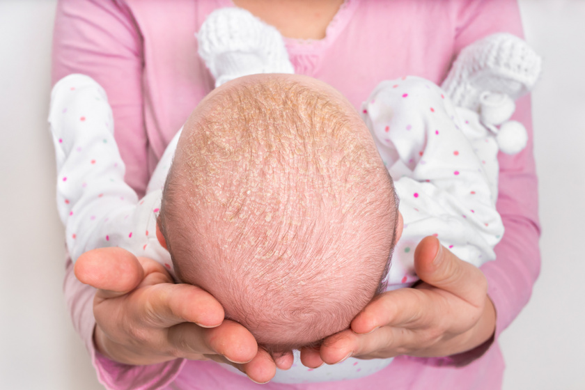 Nagyon száraz bőrű, ekcémás babák anyukái tudnátok segíteni?