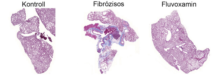 A jobb oldali, fluvoxaminnal kezelt szövet mikroszkópos képén jól látható, hogy nem alakultak ki benne súlyos fibrózisok
