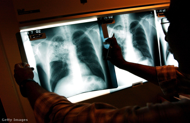 Tuberkulózisos beteg röntgenfelvétele