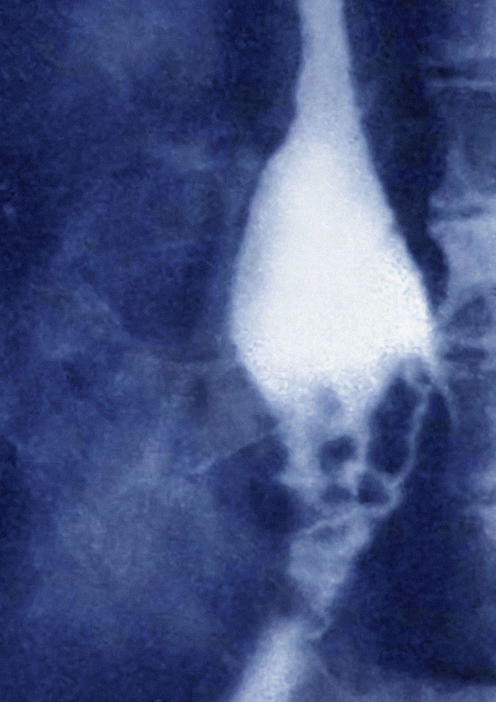 Röntgenfelvétel a nyelőcsőrákról.