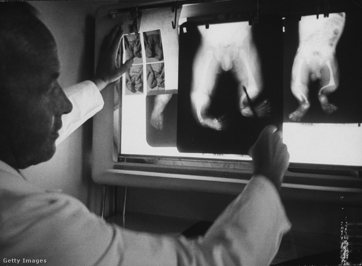 Egy ortopédiai kórház igazgatója a thalidomide miatt fejlődési rendelenességgel született csecsemők röntgenfelvételeit vizsgálja 1962-ben.