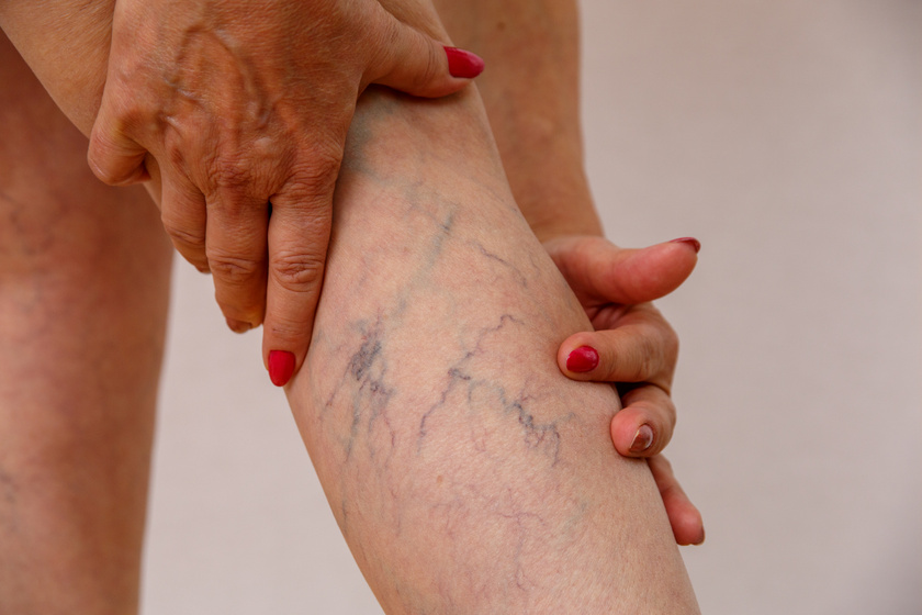 a visszér kezelése népi gyógymódokkal hatékony a varikózis kialakulása a lábakban