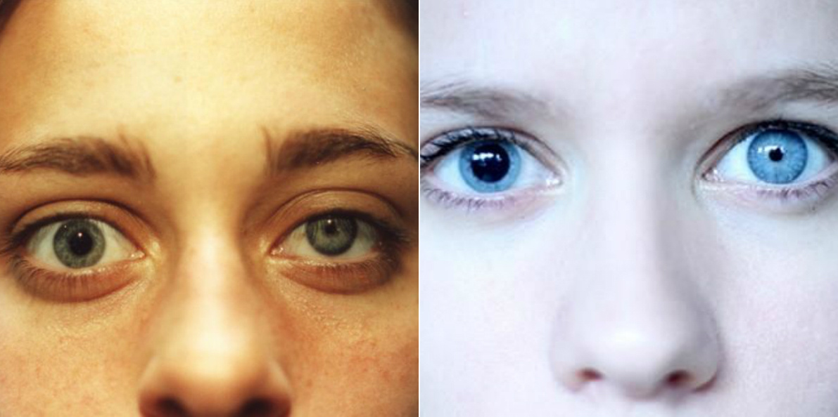 miért tágulnak a pupillák a látás ellenőrzésénél