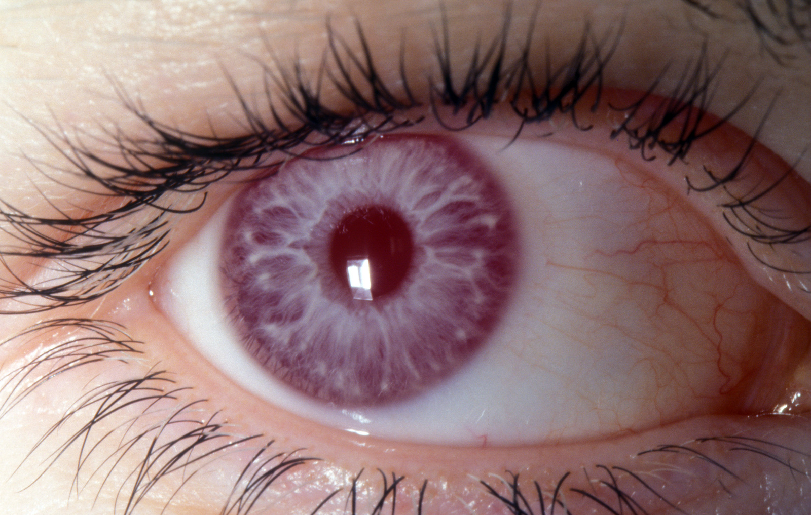 magas vérnyomás és a szem pupillái