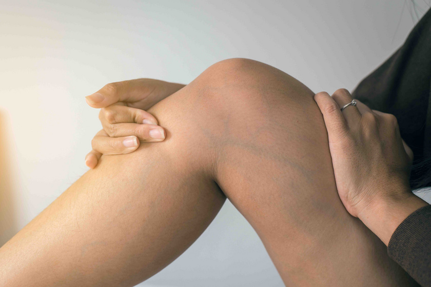 Zúzódások a lábakon, visszér fotó - Kínai varikozus foltok a lábán