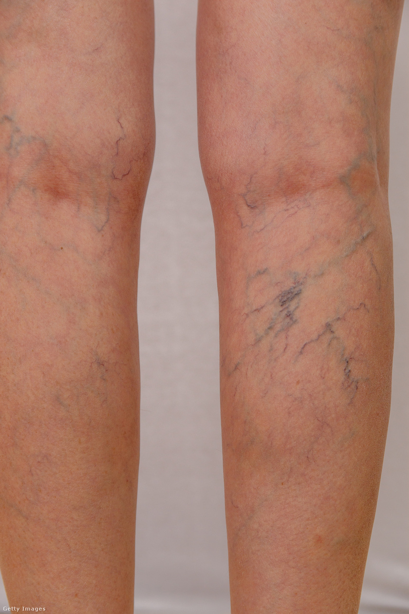a lábak varikózisának kezelése szkleroterápiával gyógyítsa meg a lábak varikózisát műtét nélkül