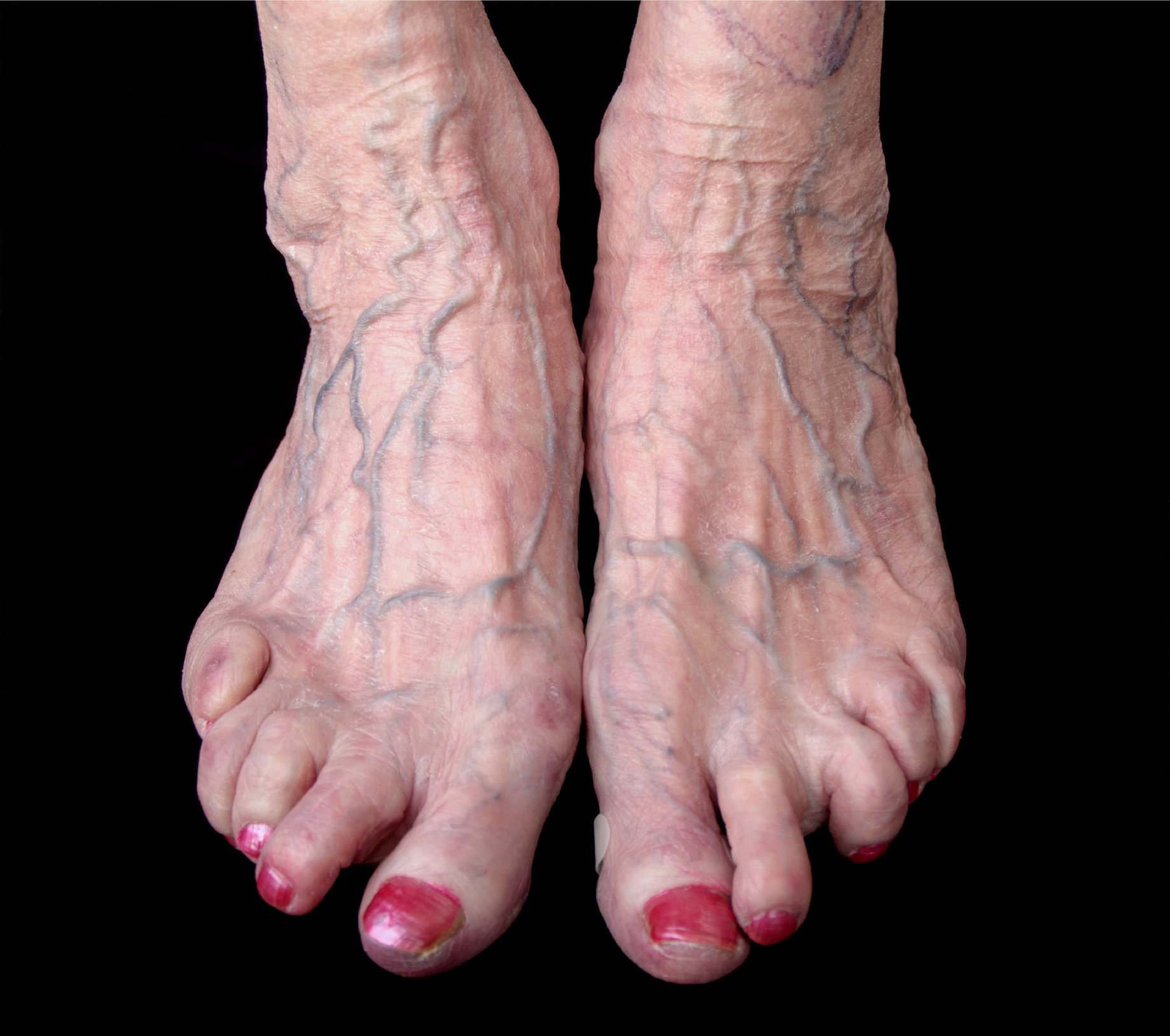 a lábujjak rheumatoid arthritis első tünetei