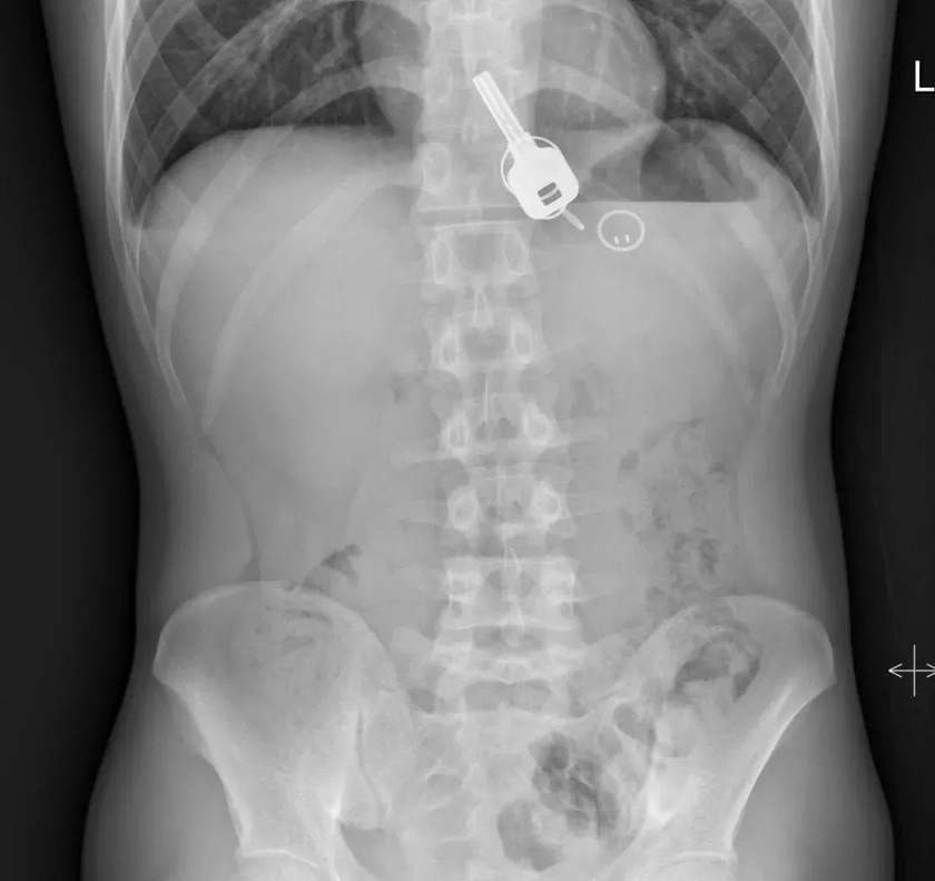 Röntgensugárzás és mindez, Újra üzemel a CT látásromlás a bal szemben