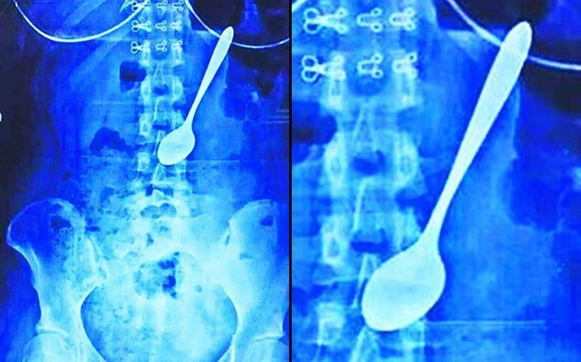 Egy 22 éves fiú gyomráról készült a röntgenfelvétel, akit egy barátja megijesztett, ennek hatására nyelte le a kanalát.