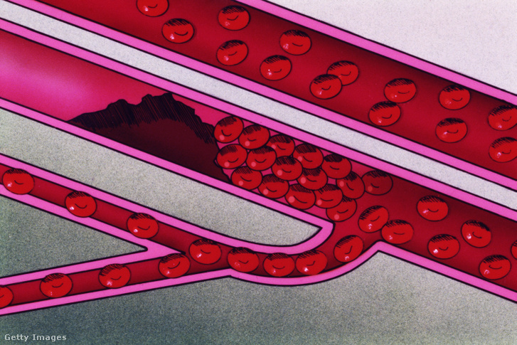 Egy vérrögös artéria illusztrációja