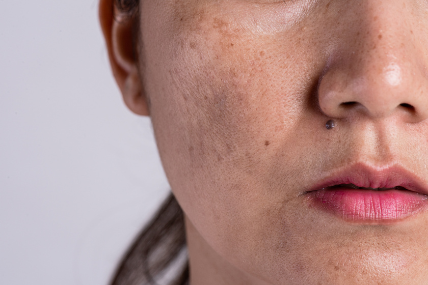 hogyan lehet eltávolítani a vörös foltokat az arc kozmetikusán