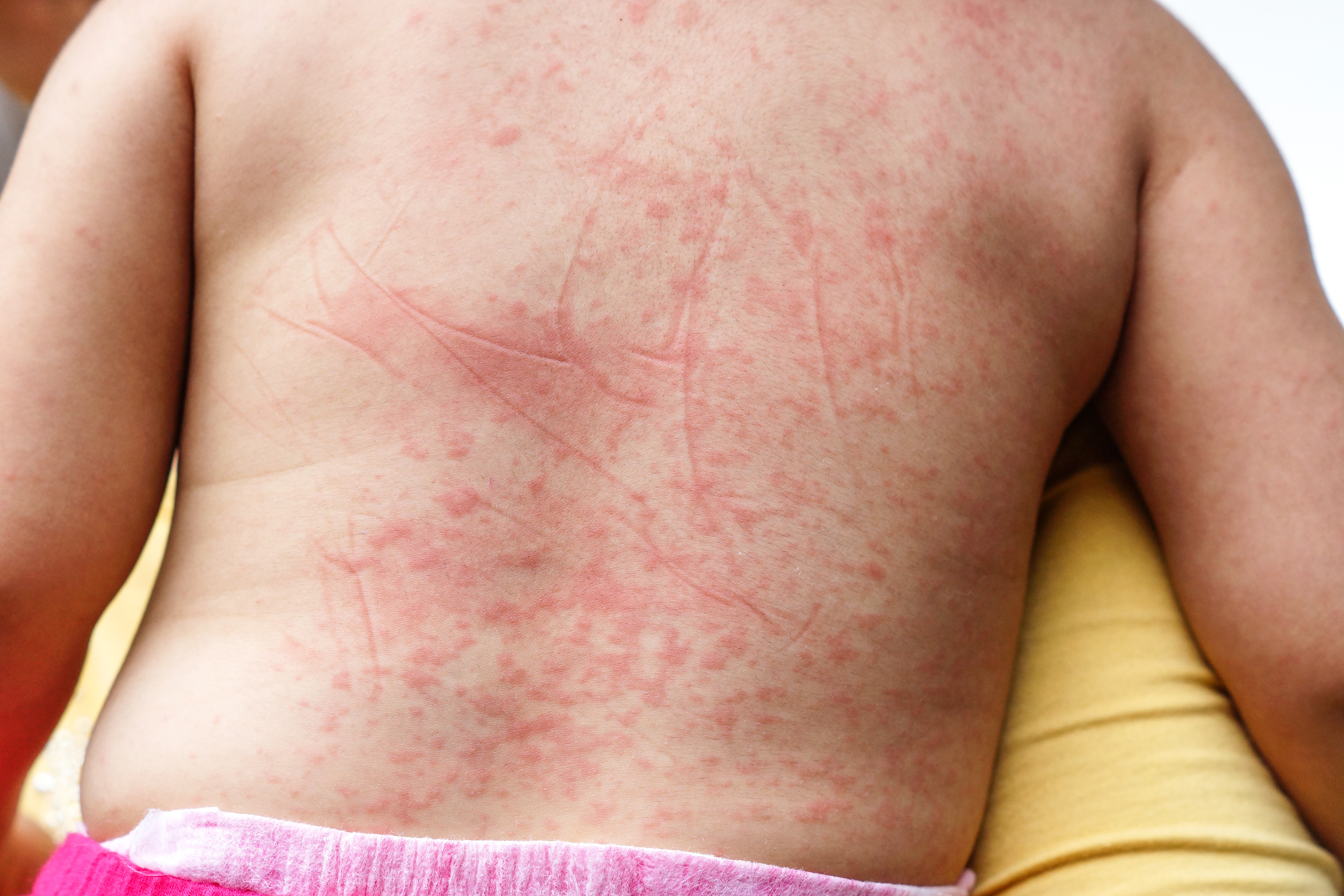 fertőző bőrbetegségek psoriasis skin lesions pictures