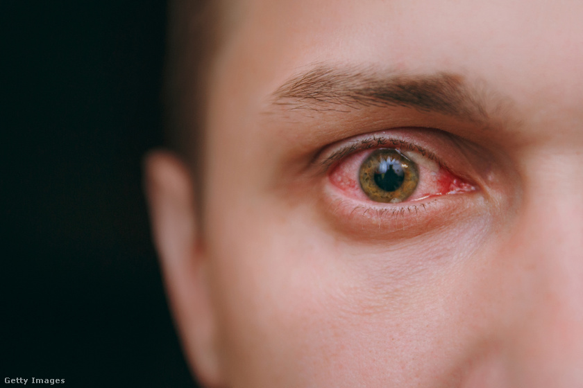 a szem tünetei inváziója