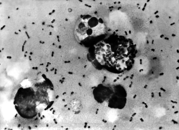 Nyirokcsomóból eltávolított bubópestis mikroszkópikus képe