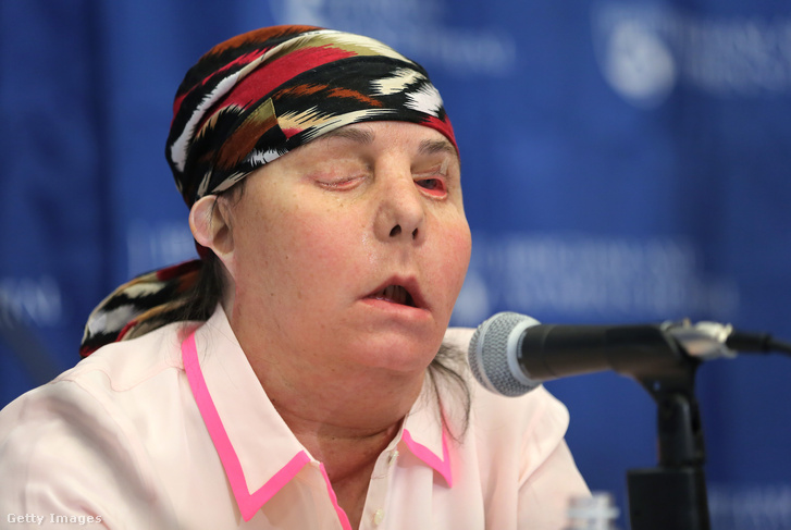 Carmen Blandin Tarleton beszél egy sajtótájékoztatón a bostoni Brigham and Women's Kórházban 2013. május 1-jén, néhány hónappal az első arcátültetése után.