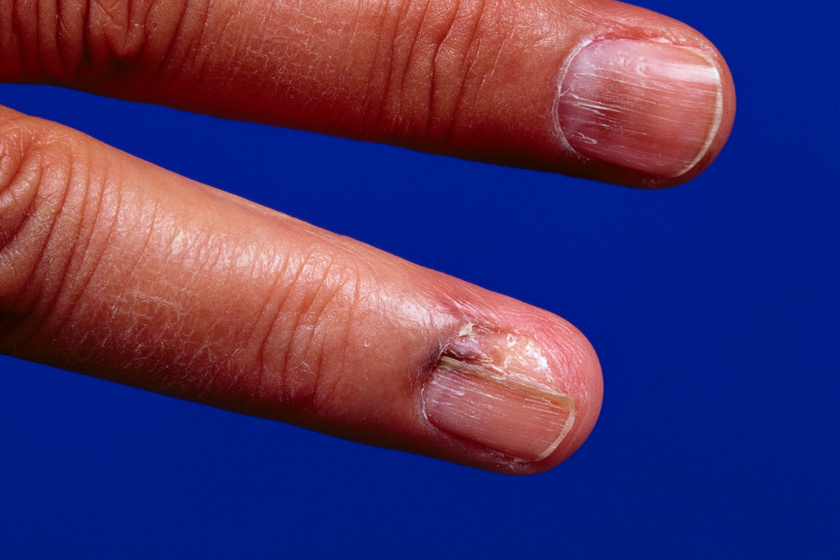kezelése ujjak és a körmök alatt cukorbetegség