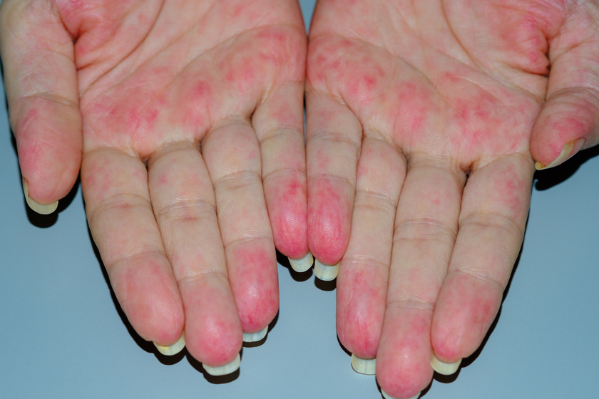 A vasculitis gyakran okoz bőrpírt.