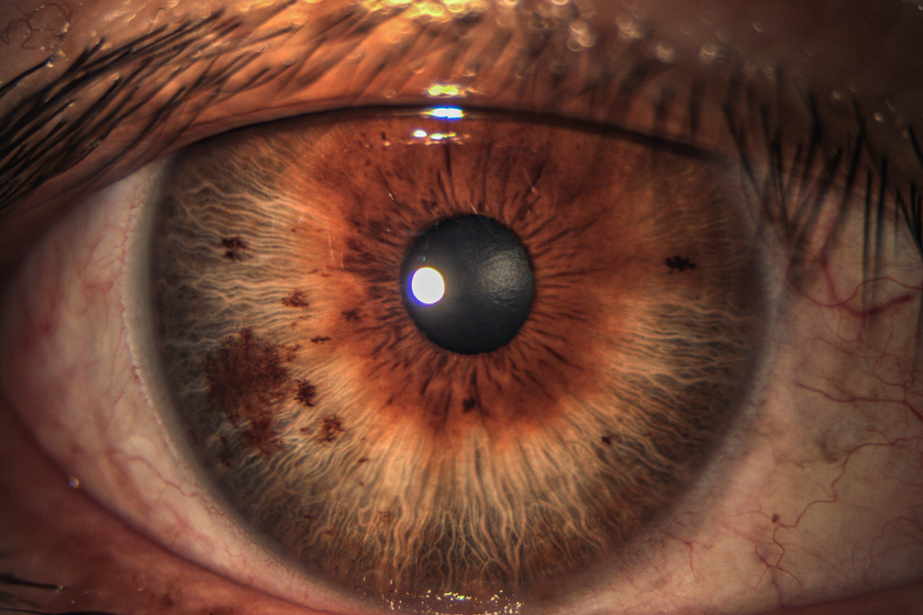 látási probléma foltok a szemben myopia a hyperopia felé
