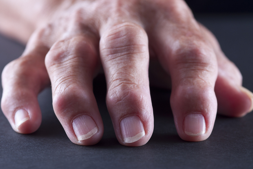 Ödémás láb Duzzadt kezek kezelése