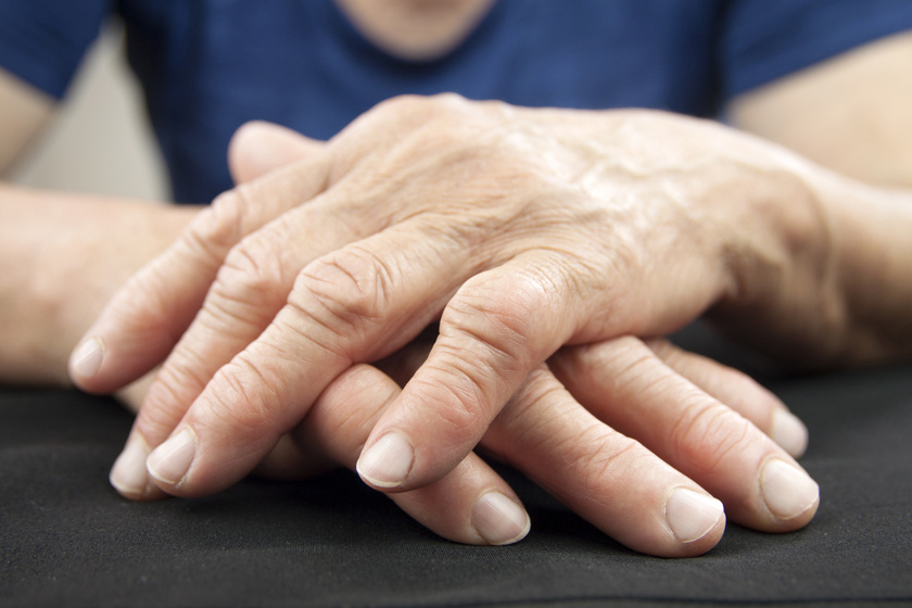 rheumatoid arthritis zsibbadt kezek