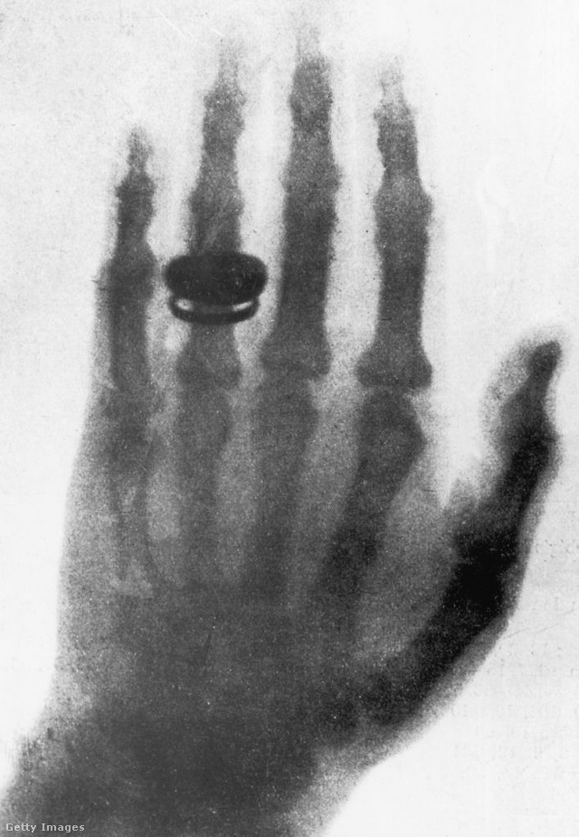 A világ első röntgenfelvétele – Röntgen a felesége kezéről készítette