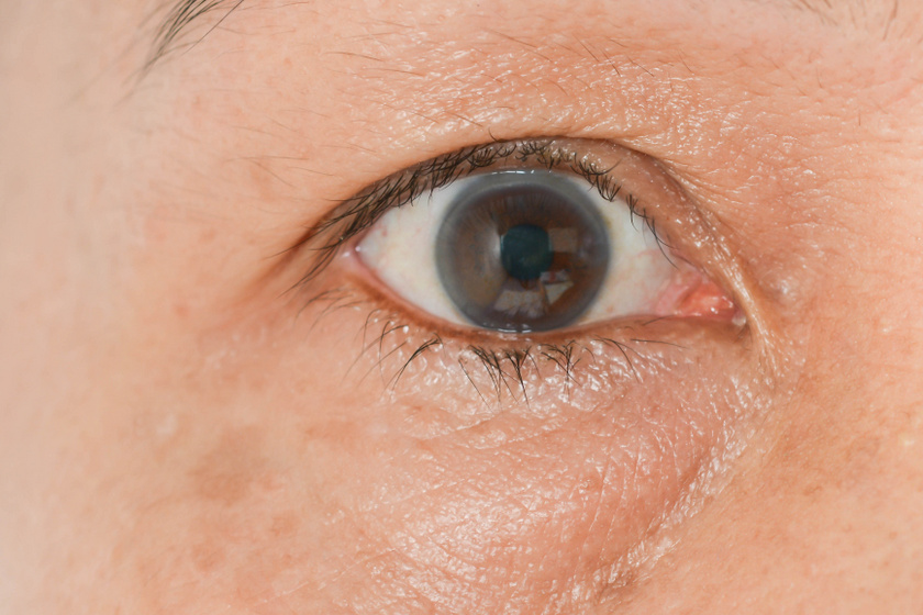 látásélesség elektromos berendezésekben végzett munka során a szemhéjak sérve befolyásolja-e a látást