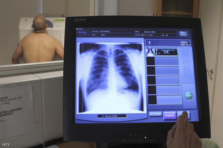 Tüdőszűrő vizsgálat 2012-ben