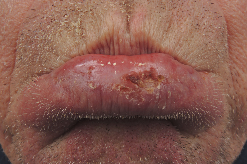 Ajakráktól a nyelvrákig: mit kell tudni a szájüregi daganatokról?
