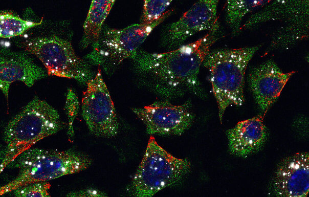Mikroszkópos képen a bőrrák tumorsejtjei a rájuk tapadt nanorészescskékkel