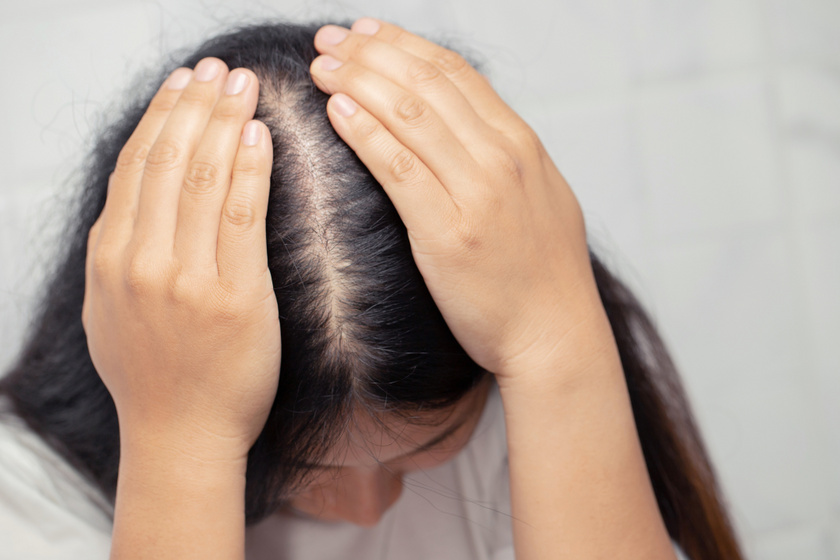 A haj érzékenyen reagál a hormonális változásokra. A hajszálak elvékonyodhatnak, töredezetté válhatnak, és több kórkép jellemzője az alopecia, azaz a hajvesztés is. Pajzsmirigy- és petefészek-problémákra utalhat többek között, gyakori kísérője a policisztás ovárium szindrómának (PCOS) és az inzulinrezisztenciának.