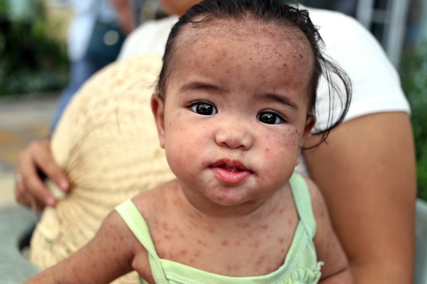 Kanyarós gyermek a Fülöp-szigeteken, 2018-ban.