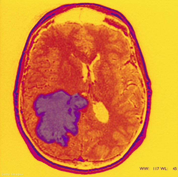 A glioblastoma MRI-képe