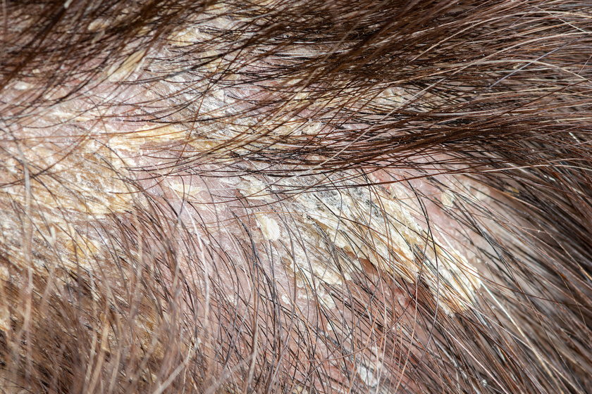 fejbőr betegségek helmint terápia alopecia