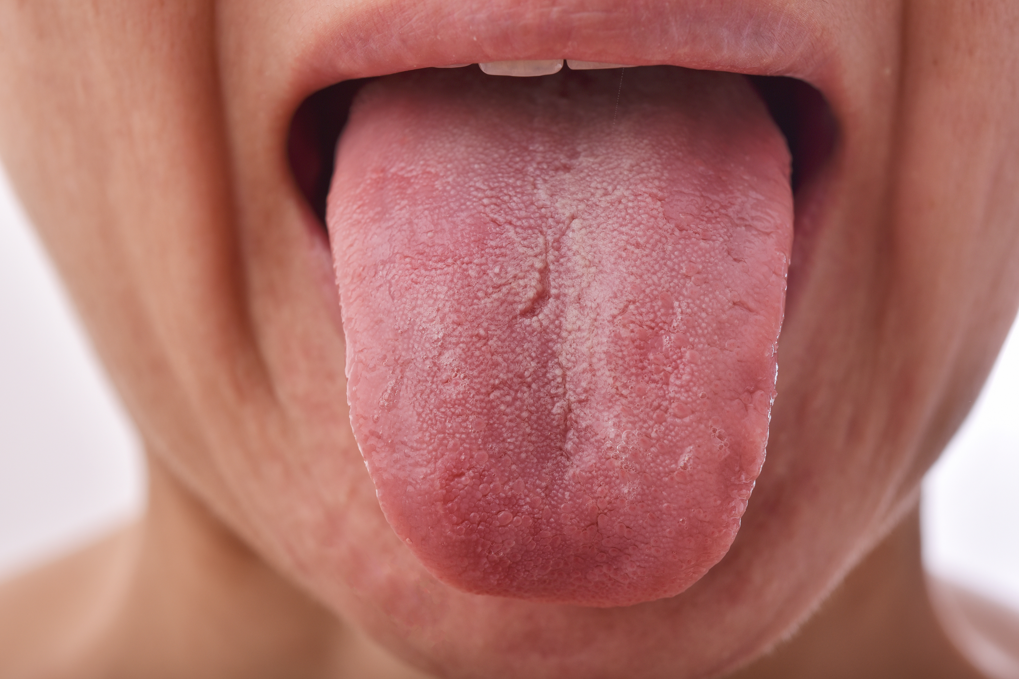 nyelv kaparás fogyás természetes gyógynövények amelyek segítenek a hasi zsír elvesztésében
