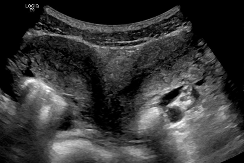 Uterus didelphys ultrahangon.