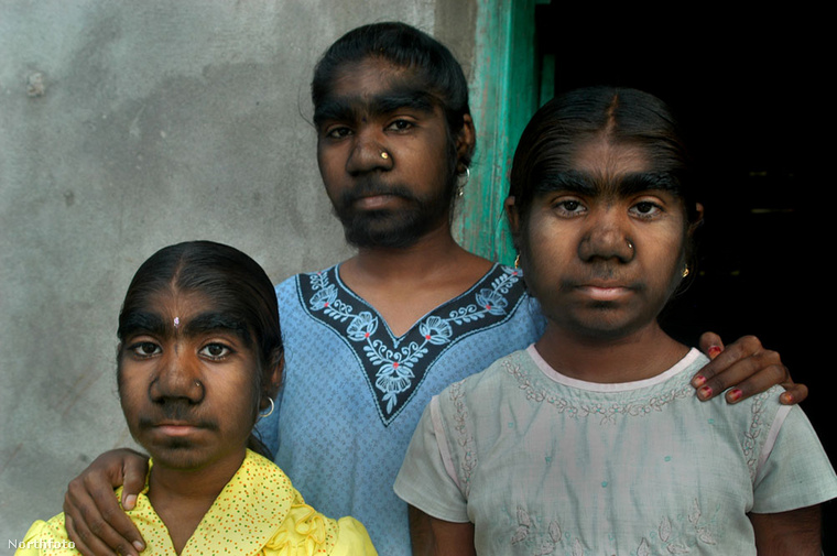 De vannak olyan családok, ahol több gyermek is szenved Ambras-szindrómában, melyért a szőrnövekedés kontrollálásért felelős sejtek meghibásodása felelős.
                        Az indiai Sangli településen élő nővérek Savita, Monisha és Savitri is a ritka genetikai rendellenességgel született, mely egyébként átlagosan egymilliárd emberből mindössze csak egyet érint