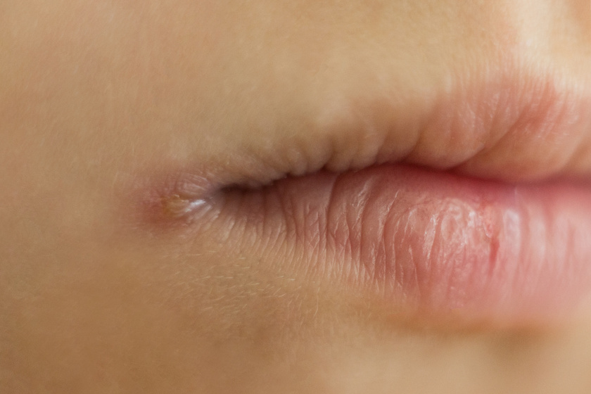 Az ajkakat érintő problémák közül az egyik leggyakoribb a szájzug berepedése (cheilitis angularis), ami érintheti csak az egyik, de akár mindkét oldalt is. Okozhatja kiszáradás, legyengült immunrendszer, kórokozók megtelepedése és B-vitamin-hiány, jellemzően a riboflavin (B2) alacsony szintje, valamint a vasban szegény táplálkozás.
