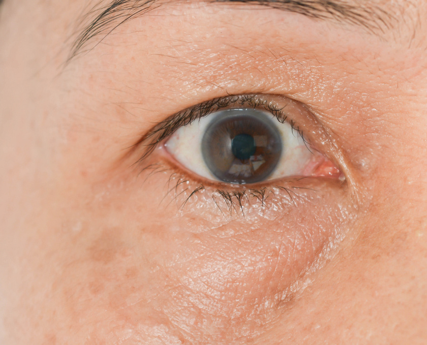 A vizenyős, puffadt szem többféle háttérproblémára utalhat. A folyadékháztartás zavarát okozhatja a vese rendellenes működése, de akár allergia vagy mozgásszegény életmód is állhat a látványos tünet mögött.