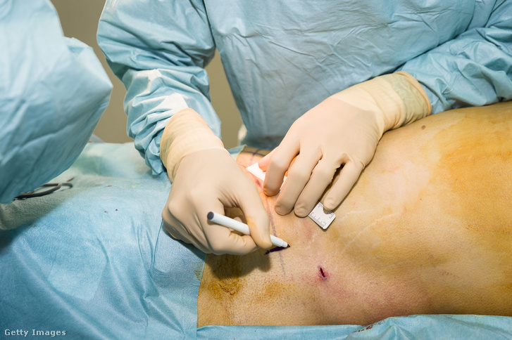 Hasplasztikaműtét