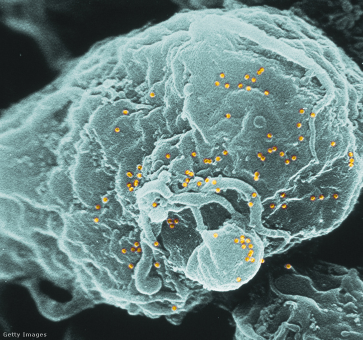 HIV-vírusok (sárgával) egy emberi immunsejten, elektronmikroszkóp alatt