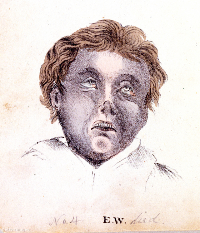 Kolerás beteg egy amerikai illusztráción (1832)