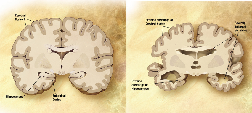 Egy egészséges (balra) és egy Alzheimer-kóros beteg (jobbra) agyának összehasonlítása