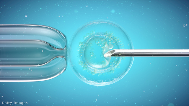 100 IVF-eljárásból 25 végződik sikeresen, vagyis szüléssel