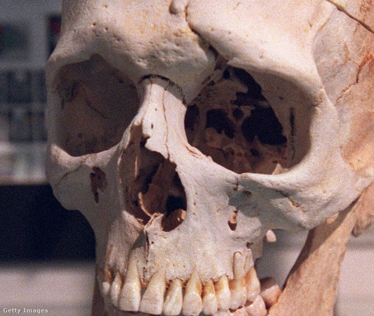 Phineas Gage koponyája a Warren Anatómiai Múzeumban