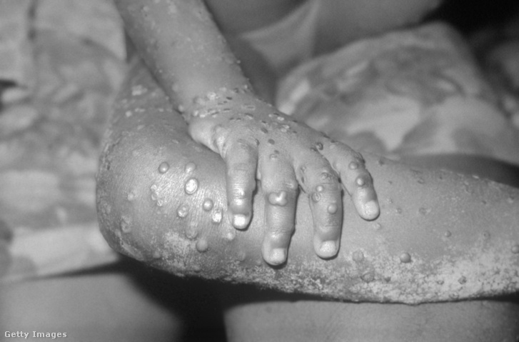 Majomhimlő-fertőzésből eredő elváltozások egy beteg bőrén.