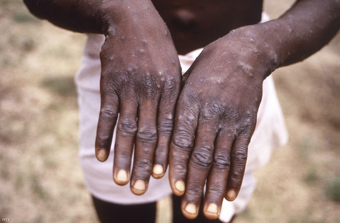 Az amerikai Járványügyi és Betegségmegelőzési Központ, a CDC által 2022. május 21-én közreadott, 1997-ben készített kép egy majomhimlővel fertőzött beteg kézfejéről a Kongói Demokratikus Köztársaságban