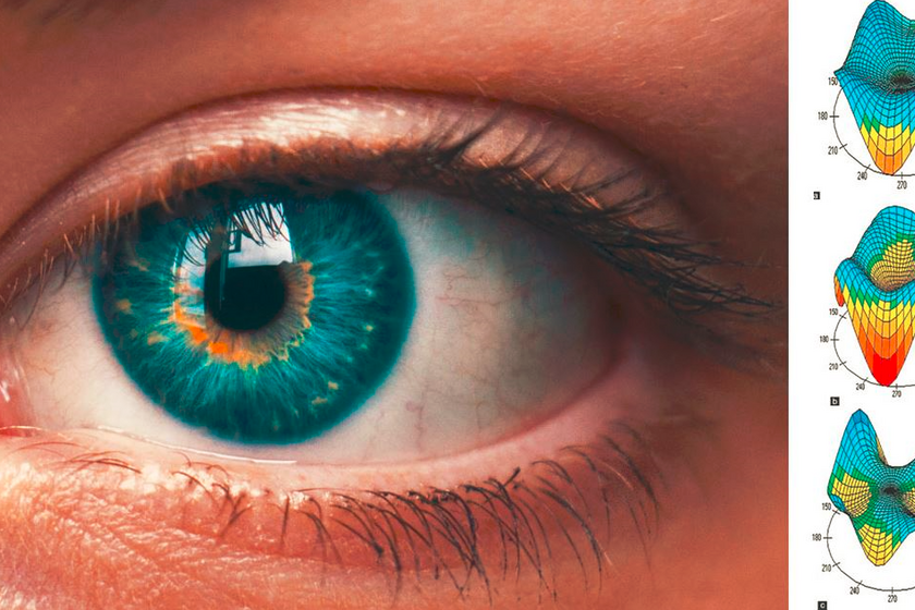 A lézeres szemműtétet megelőző alkalmassági vizsgálat során 200-300 ezer adat készül a szemről.