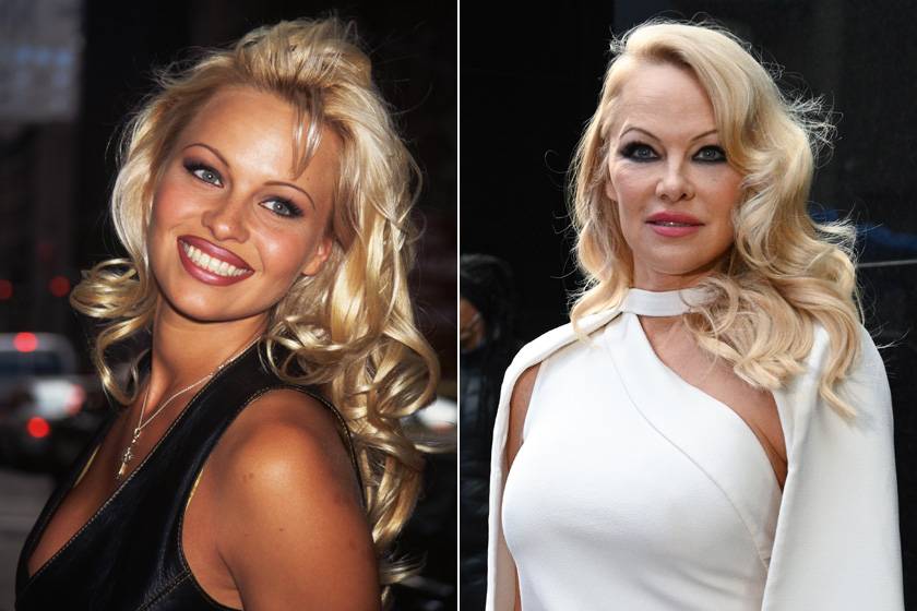 A Baywatch gyönyörű sztárjának arca 55 éves korára nagyon megváltozott. Pamela Anderson arca eldeformálódott, szemöldöke is furcsán áll, de valószínűleg a botoxot sem utasította vissza.