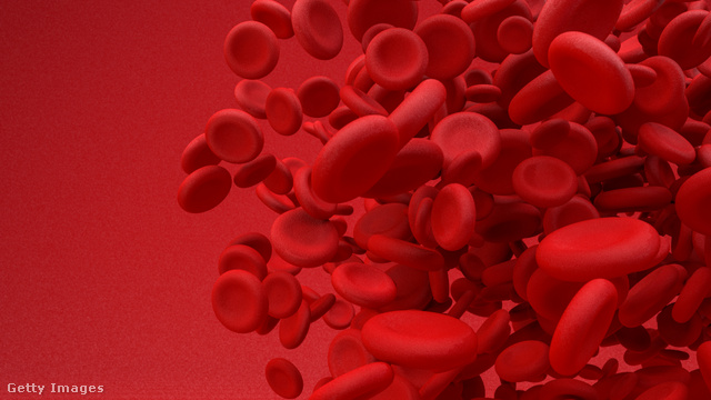 Vashiányos vérszegénység akkor fordul elő, ha a vörösvértestek hemoglobinszintje csökken: okát érdemes megkeresni