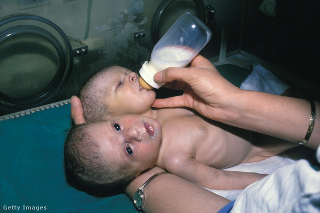 Kétfejű iráni baba 1987-ben
